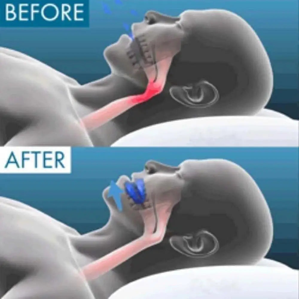 Adjustable Anti-Snoring Mouth Guard – Snoring & Bruxism Relief for Better Sleep
